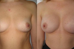 mastoplastica-additiva-donna-anni-35-id-2093