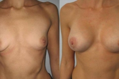 mastoplastica-additiva-donna-anni-36-id-106