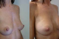 mastoplastica-additiva-donna-anni-36-id-1944