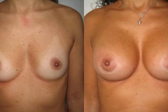 mastoplastica-additiva-donna-anni-36-id-55