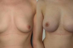 mastoplastica-additiva-donna-anni-36-id-75
