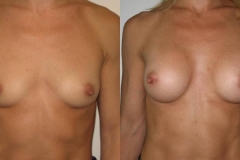 mastoplastica-additiva-donna-anni-36-id-91