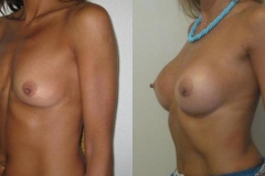 mastoplastica-additiva-donna-anni-40-id-1998