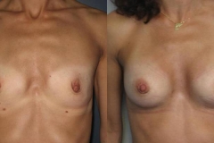 mastoplastica-additiva-donna-anni-43-id-57