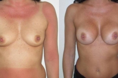 mastoplastica-additiva-donna-anni-43-id-95