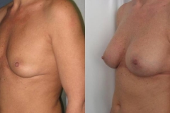 mastoplastica-additiva-donna-anni-44-id-31