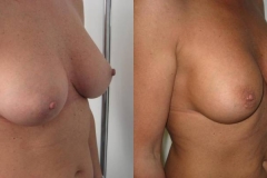 mastoplastica-additiva-donna-anni-44-id-32