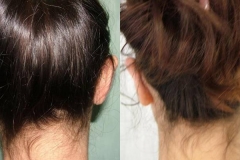 otoplastica-donna-anni-24-id-942