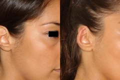 otoplastica-donna-anni-26-id-680