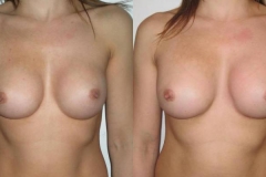 sostituzione-protesi-donna-anni-31-id-718