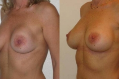 sostituzione-protesi-donna-anni-43-id-721